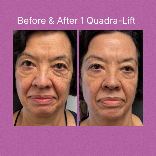 Quadra-Lift